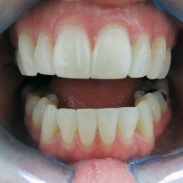 Claire's teeth after invisalign