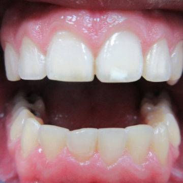 Michael's teeth after Invisalign