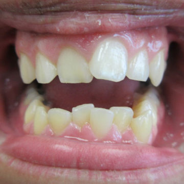 Michale's teeth before invisalign